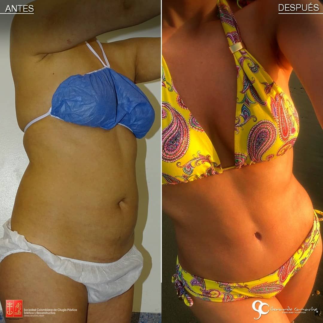 Resultado de abdominoplastia en Bogotá